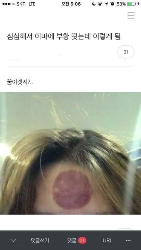 심심해서 부황 뜬 여자